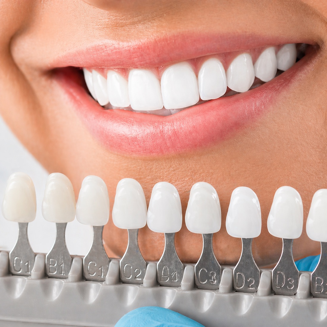 Porcelain veneer shade-matching close-up